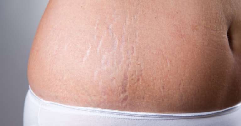 Az alábbiakban részletesen bemutatjuk Rubos Vivien kozmetikus segítségével, hogyan történik a terhességi csíkok kialakulása